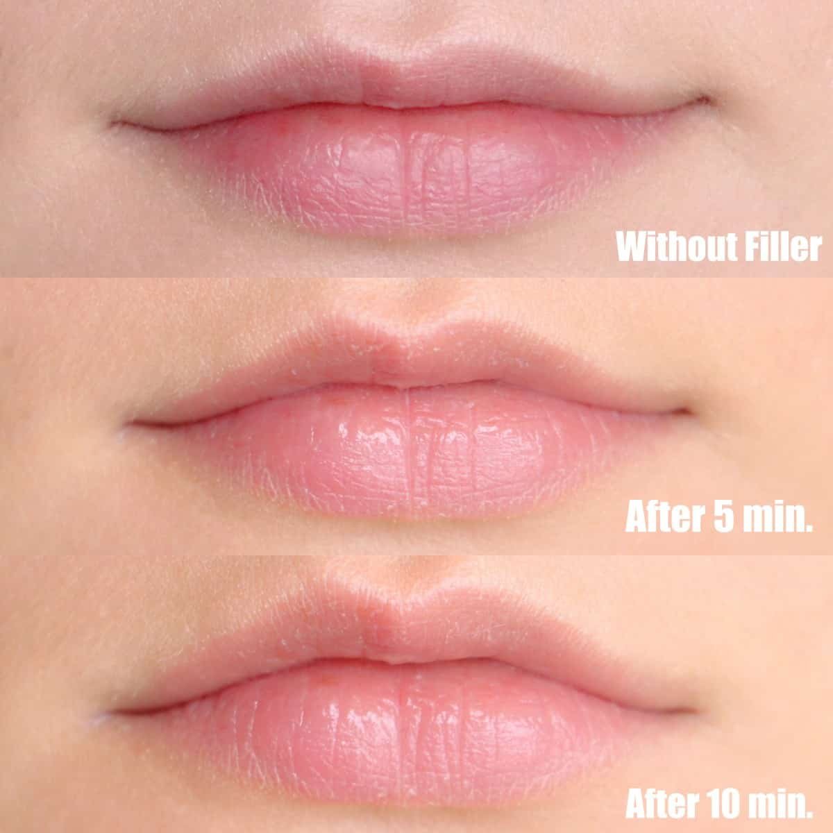 DermoFuture Hyaluronic Lip Filler Review